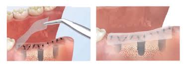 TBM Ora-Aid Attachable intraoral wound dressing